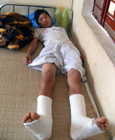 Gãy 2 chân, vỡ xương cột sống vì trèo cây bắt chim - 1 Gãy 2 chân, vỡ xương cột sống vì trèo cây bắt chim