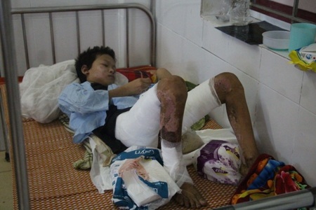 Cháu T. bị bỏng trên 40% và hiện không có phần da nào để tiến hành cấy ghép