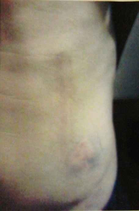 Anh Lai bị đánh thâm tím khắp người