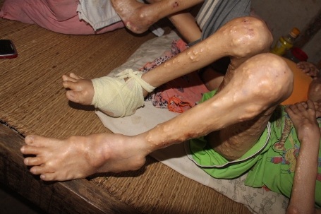 Đôi chân của Sơn và Tài giờ nổi chi chít những cục u như thế này