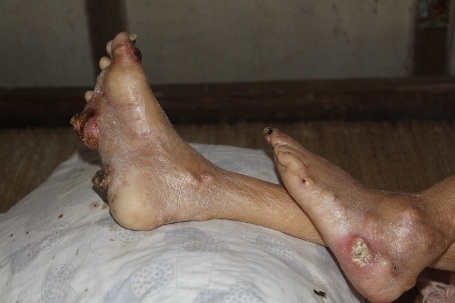 Em Sơn giờ bệnh tình đang rất nặng, khắp cơ thể mọc chi chít khối u và bắt đầu lở loét