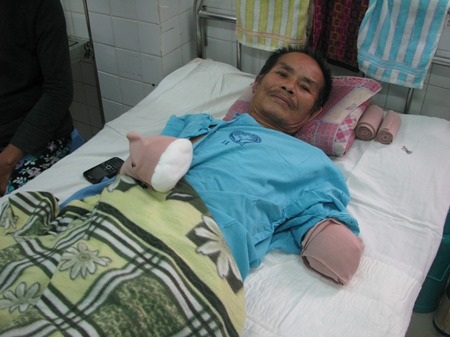 Ông Bình phải cưa hai tay để cứu tính mạng