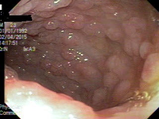Phát hiện hàng ngàn polyp trong đại trực tràng 1 thanh niên - 1 Hàng ngàn polyp được phát hiện trong đại trực tràng của bệnh nhân