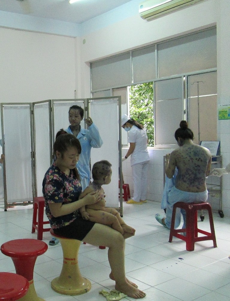 Bệnh tay chân miệng tăng, thủy đậu và sốt xuất huyết giảm - 1 Bệnh nhân đang điều trị bệnh thủy đậu tại Bệnh viện da liễu Đà Nẵng