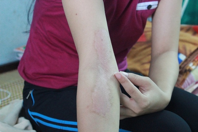 Sinh viên Huế khổ vì kiến ba khoang - 3 Những vết đốt gây thương tích trên diện rộng cho SV