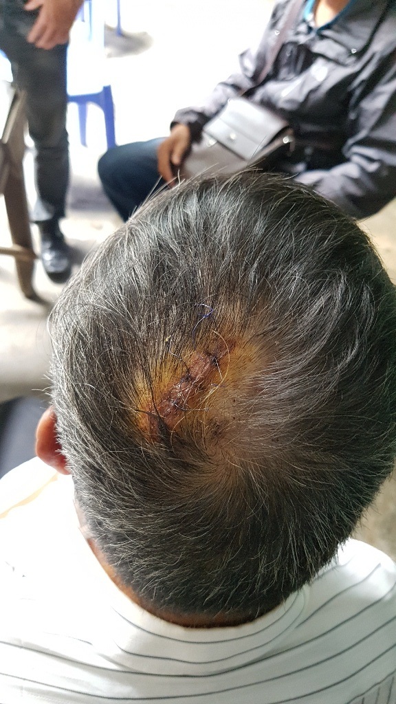 Thừa Thiên Huế: Trưởng hội người mù và con trai bị vào tận nhà đánh trọng thương - 2 Chiếc áo đầy máu và vết thương trên đầu ông Lộc