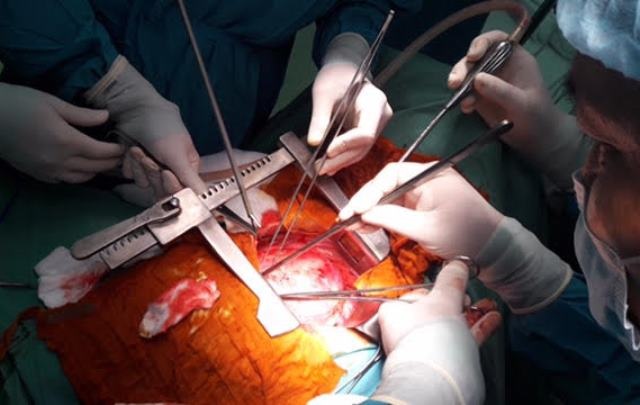 Khối u quái bẩm sinh nằm sát tim bệnh nhân suốt 41 năm - 1 Các bác sĩ đang phẫu thuật bóc tách khối u cho bệnh nhân T.