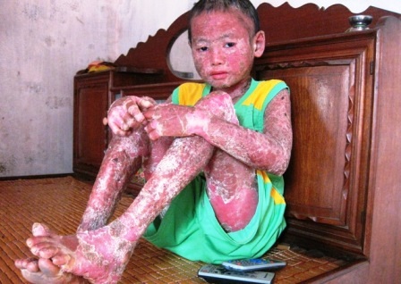 Mỗi tháng, những nốt mù và vảy nến trên người cháu mọc nhiều nhất là khi bắt đầu tuần trăng lên.