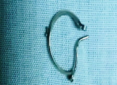 Bé gái 5 tháng tuổi nuốt khuyên tai vào thực quản - 1 Chiếc khuyên tai được gắp ra từ thực quản của bé H.