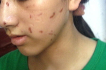 Khuôn mặt em L. có nhiều vết trầy xước do bị đánh.