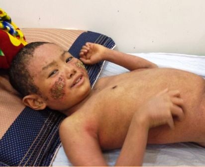  Bệnh vảy nến lặn gần hết đem lại cho cháu Kỳ làn da mới không còn sần sùi như trước.