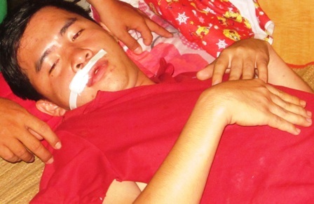 Anh Giang bị trọng thương ở mặt đang điều trị ở bệnh viện