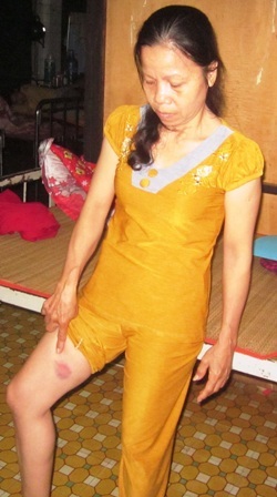 Vết thương ở đùi của bà Thuỷ sau khi bị Phó trưởng công an xã bắn