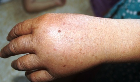 Bàn tay bà Bé vẫn còn bị sưng sau hơn 1 tuần bị rắn lục đuôi đỏ cắn