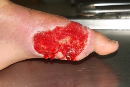 Bị rắn cắn nếu không được điều trị kịp thời sẽ bị sưng, lở loét có thể nguy hiểm đến tính mạng