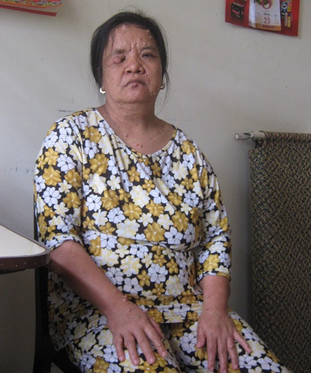 Người phụ nữ hơn 20 năm mang trên người bộ “da cóc” - 1 Khối bướu che hết mắt phải chị Linh