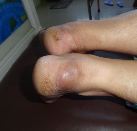 Sau khi tiêm thuốc có chứa corticoit, 2 gót chân chị tuyết bị sưng mủ và đứt gân