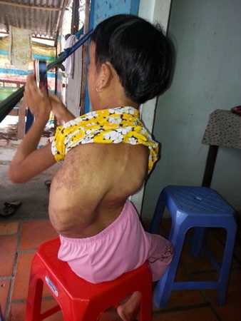 Thương em bé 6 tuổi mắc bệnh lạ "bên trái to ra, bên phải teo lại" - 2 Cột sống của cháu Thắm cong vẹo nhưng không có tiền đi khám chữa trị