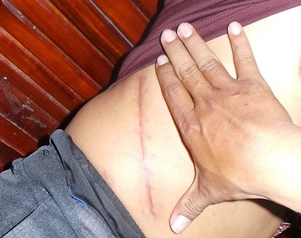 Vết mổ của một nông dân sau khi đã bán thận với giá hơn 100 triệu đồng (ảnh Phạm Tâm)