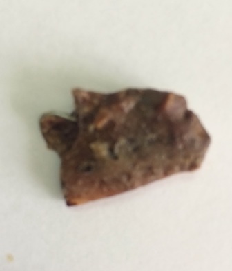 Khung hàm răng giả  bị bị thất lạc 20 năm được lấy ra từ thùy giữa phổi phải của bệnh nhân T