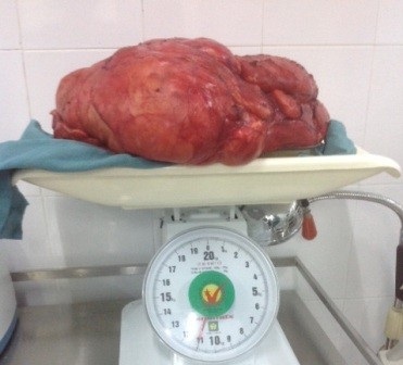 Phẫu thuật khối u hơn 10kg trong bụng bệnh nhân - 1 Khối u nặng hơn 1 yến được các bác sĩ Bệnh viện ĐKTP Cần Thơ phẫu thuật thành công