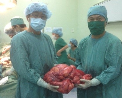 Phẫu thuật khối u hơn 10kg trong bụng bệnh nhân - 3 2 bác sĩ phẫu thuật ôm khối u nặng hơn 1 yến của bệnh nhân X