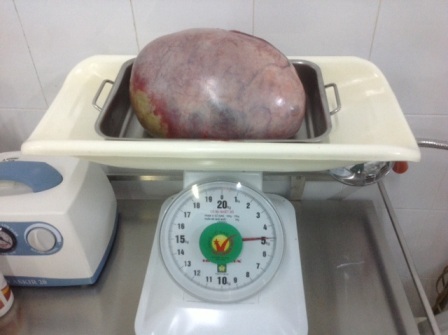 23 tuổi mang khối u buồng trứng 5kg - 1 Khối u 5kg được lấy ra từ ổ bụng của bệnh nhân T