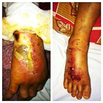 Tay chân bị sưng phù, hoại tử do ăn rắn cắn (ảnh bác sĩ Hoàng Xuân Thục cung cấp)