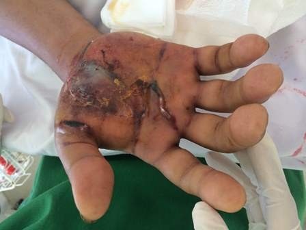 Đứng xem hoa mận, bị rắn lục lao vào cắn  - 2 Bàn tay ông ông Năm bị nhiễm trùng nặng do rắn lục đuôi đỏ tấn công