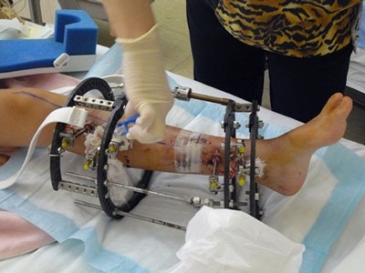 Cẩn thận với hệ lụy từ phẫu thuật kéo dài chân - 1 Cẩn thận với hệ lụy từ phẫu thuật kéo dài chân - 1