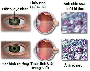 Dư luận gay gắt trước vụ việc ở bệnh viện Mắt Hà Nội - 1 Dư luận gay gắt trước vụ việc ở bệnh viện Mắt Hà Nội - 1