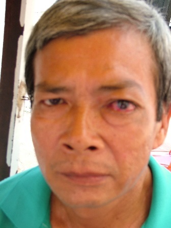 Người đàn ông mong đủ tiền mổ mắt để không bị bại liệt - 1 Mắt trái của ông Tâm ngày càng lồi ra, chi chít những đường gân máu, thị lực giảm sút