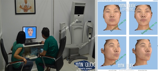 Phẫu thuật khuôn mặt V line và trái xoan - 1 BS tư vấn bệnh nhân phẫu thuật khuôn mặt V line với máy Vectra 3D