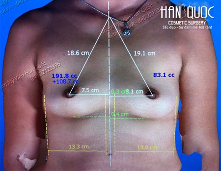 Nâng ngực với túi giả định công nghệ Mỹ - 1 Máy đo túi ngực đưa ra số liệu chính xác