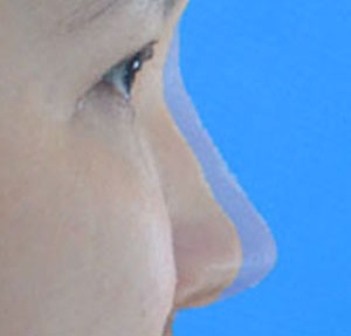 Nâng mũi S line - 3 Tạo hình mũi giả định với công nghệ mới