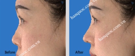 Nâng mũi S line - 4 Hình trước và sau trãi nghiệm với công nghệ giả định Mỹ