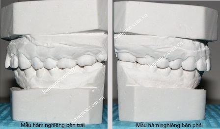 Phẫu thuật chỉnh nha hàm hô - 3 Mẫu hàm sau khi lấy dấu từ bệnh nhân