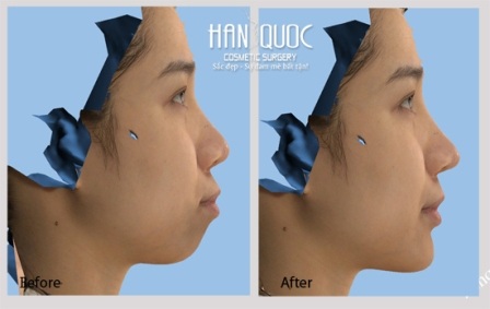 Phẫu thuật chỉnh nha hàm hô - 6 Chỉnh sửa khuôn mặt theo công nghệ Vectra 3D duy nhất tại Việt Nam