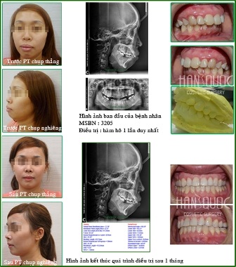 Phẫu thuật chỉnh nha hàm hô - 9 Hình trước và sau phẫu thuật hàm hô