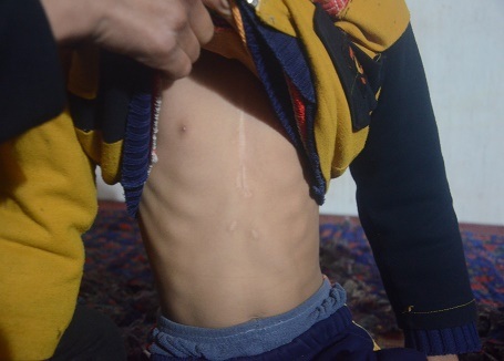 Cậu bé Đạt mới được một Nhà Dòng tài trợ phẫu  thuật, với vết mổ dài trên ngực.