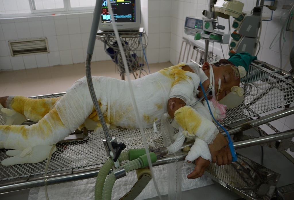 Bé Khánh Huyền bị bỏng sâu 65% cơ thể đang nằm cấp cứu tại Viện bỏng Quốc gia, Hà Nội