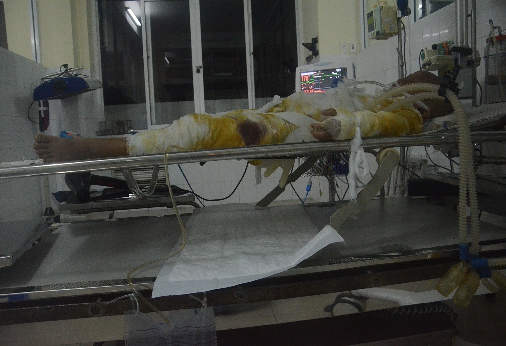 Em đang được điều trị tích cực tại khoa hồi sức cấp cứu, viện Bỏng quốc gia.