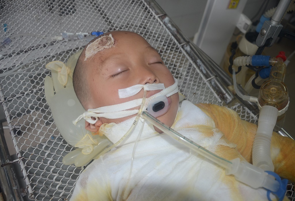 Bé Khánh Huyền bị bỏng sâu 65% cơ thể đã qua đời