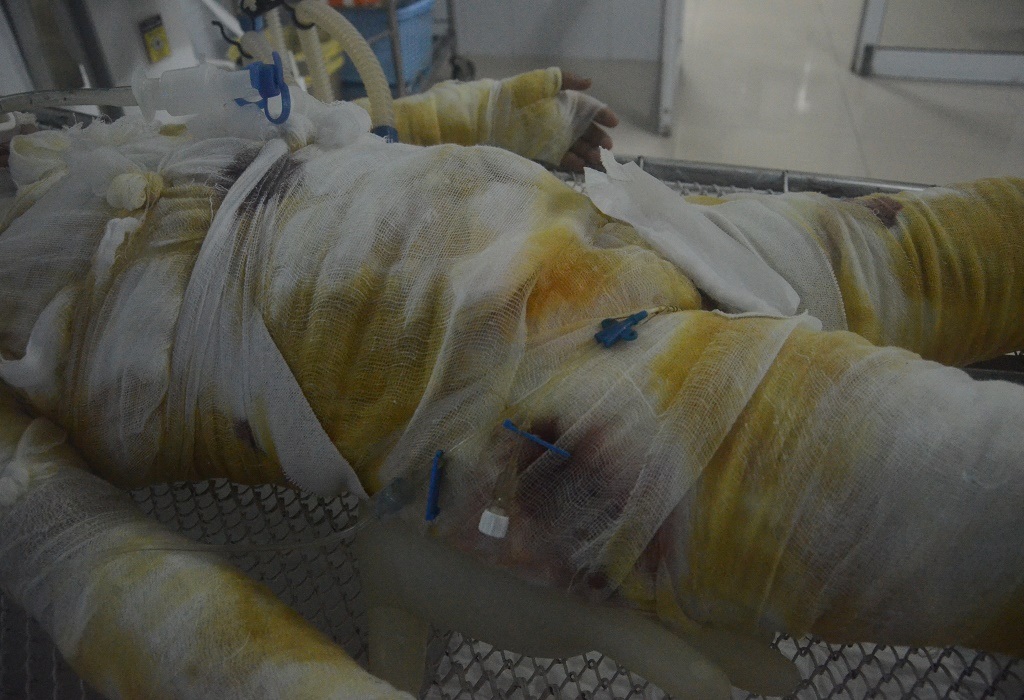 Tình trạng này có lẽ sẽ còn kéo dài, bởi em bị bỏng rất sâu, nhiều chỗ trên cơ thể đã bị hoại tử