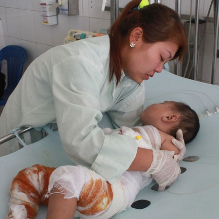 Ngã vào nồi nước sôi, bé 21 tháng tuổi nguy kịch - 1 Con đau đớn luôn mồm rên rỉ, chị cũng khóc lặng theo con