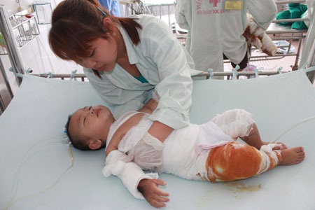 Ngã vào nồi nước sôi, bé 21 tháng tuổi nguy kịch - 2 Bé Đại Thiên bị bỏng 40% cơ thể, trong đó nặng nhất phần bụng, lưng, đùi và tứ chi