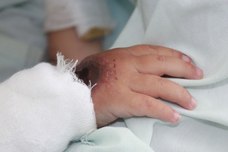 Ngã vào nồi nước sôi, bé 21 tháng tuổi nguy kịch - 5 Bàn tay bị bỏng sâu của em vẫn không quên nắm lấy mẹ như cầu cứu