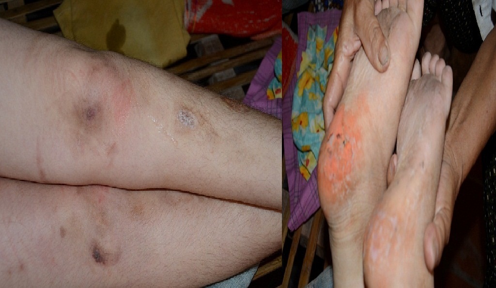 Nhiều chỗ trên cơ thể đã bắt đầu lở loét hoại tử