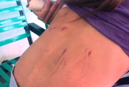 Chị Th. với nhiều thương tích còn trên lưng do bị khống chế, hiếp dâm.