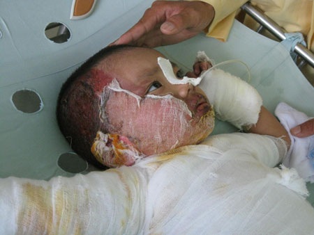 Thương bé 2 tuổi bị bỏng nặng - 1